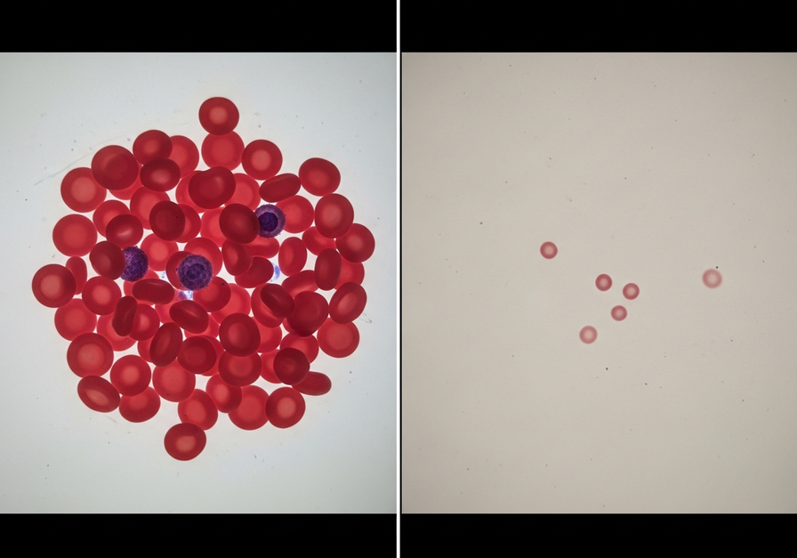 A split-screen microscope image comparing dense healthy red blood cells on the left with sparse anemic blood cells on the right.